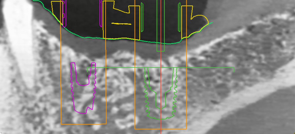 Navigierte Implantologie - Beispielbild 2