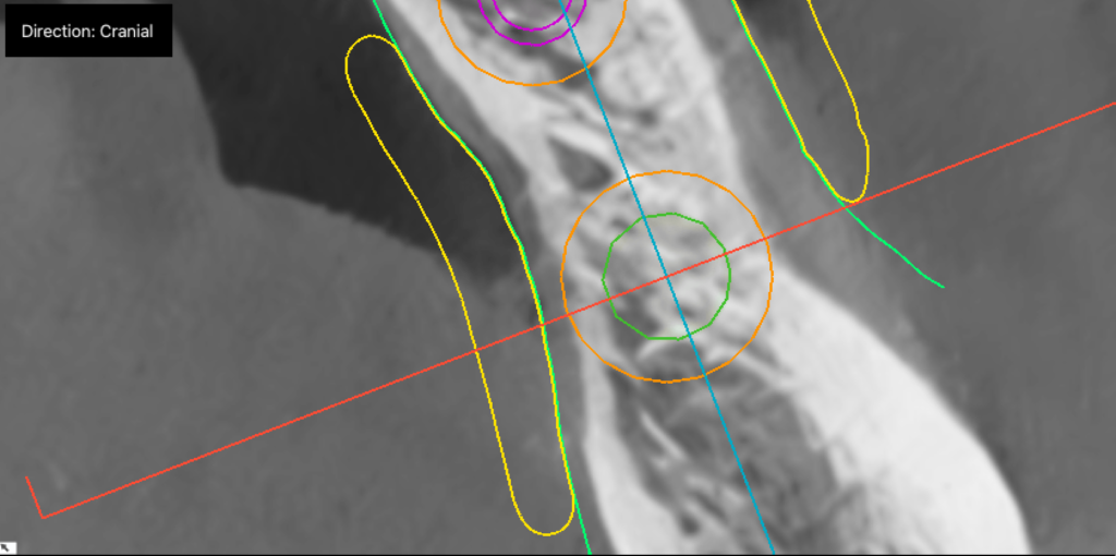 Navigierte Implantologie - Beispielbild 4