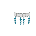 SKY fast & fixed in Salem am Bodensee: Erleben Sie feste Zähne & ein strahlendes Lächeln an nur einem Tag. 